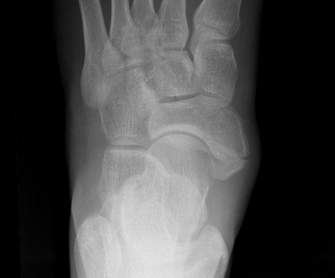 Accessory Navicular Fractured Synchondrosis